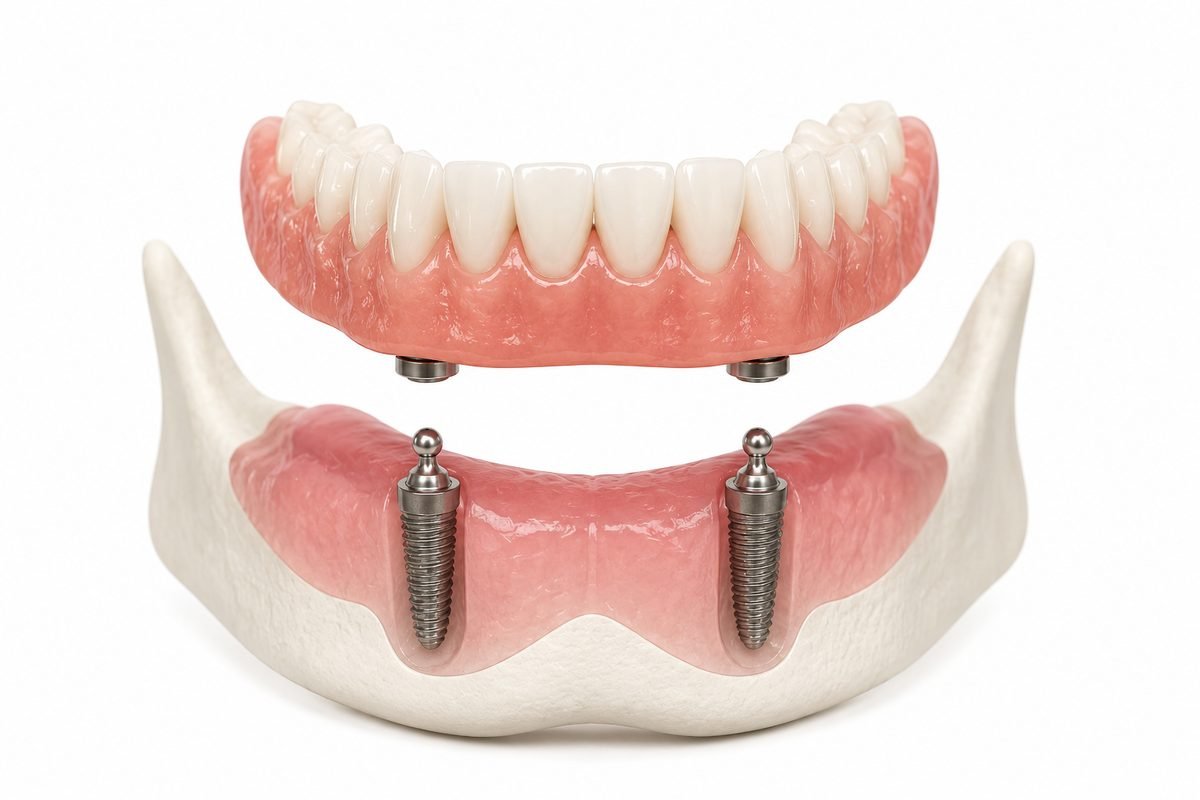 Implant-supported denture anchored to dental implants in the jawbone