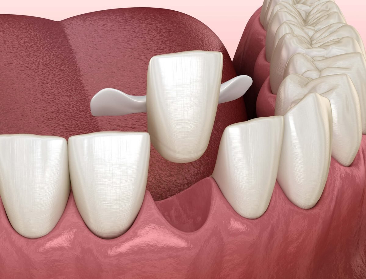Maryland bridge — a conservative bridge bonded to the back of adjacent teeth, used as an interim solution while a dental implant integrates