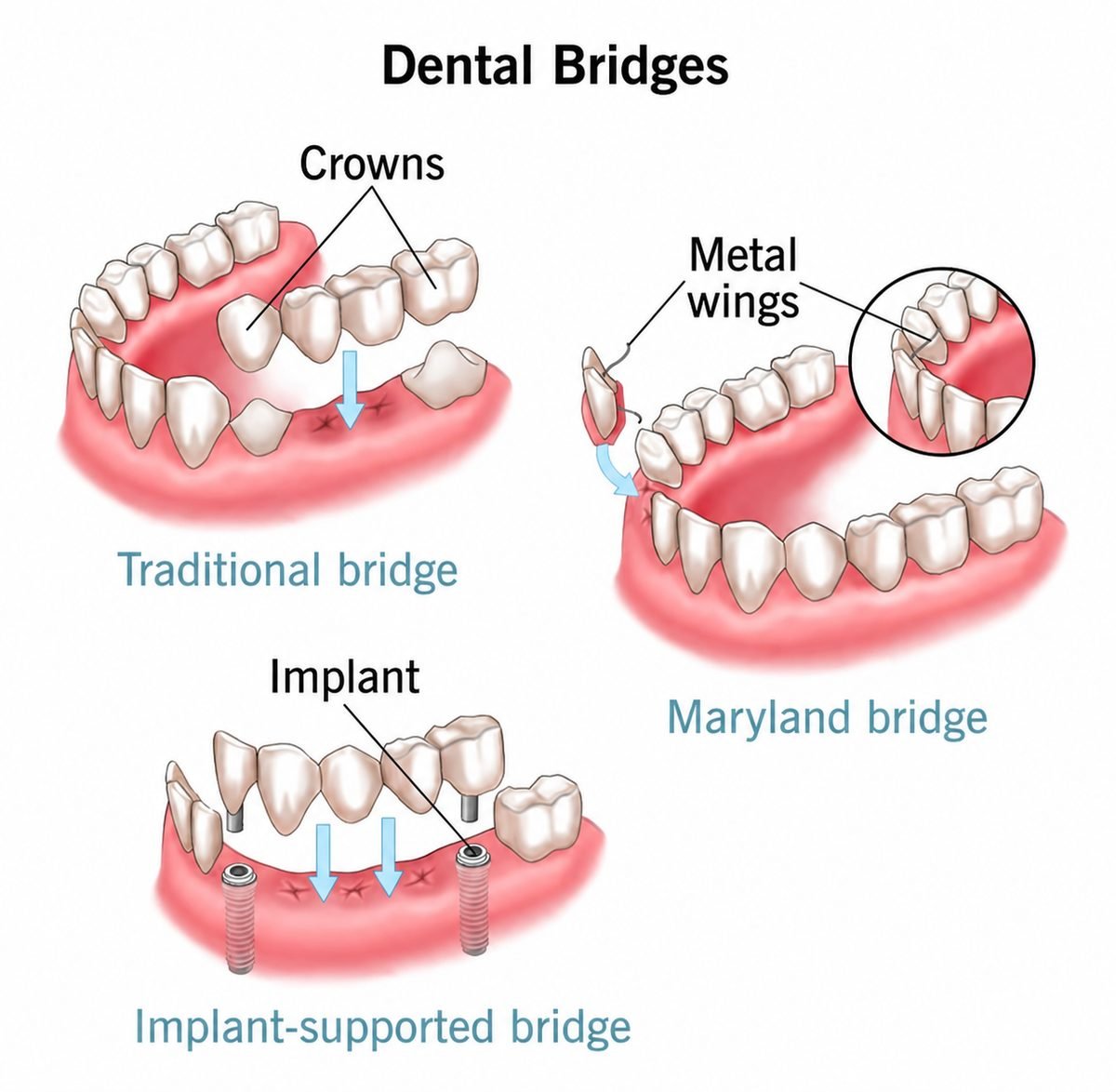 Visual comparison of dental bridge types — PFM, Zirconia, Maryland, and other configurations