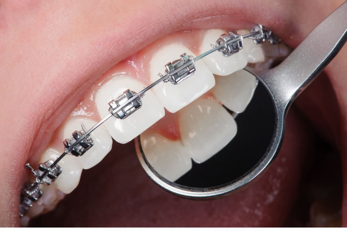 Conventional metal braces