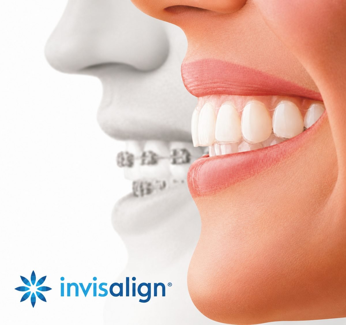 Invisalign clear aligners