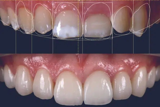 Smile Design and Veneers