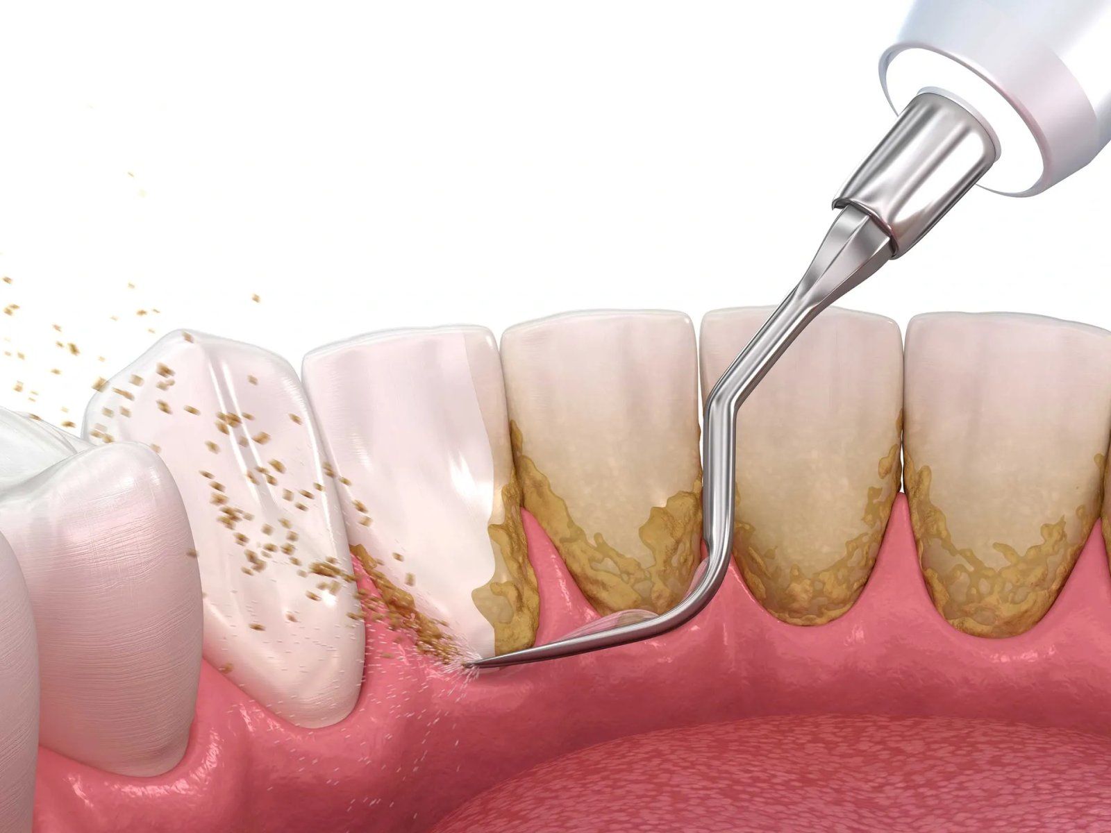 Teeth Cleaning