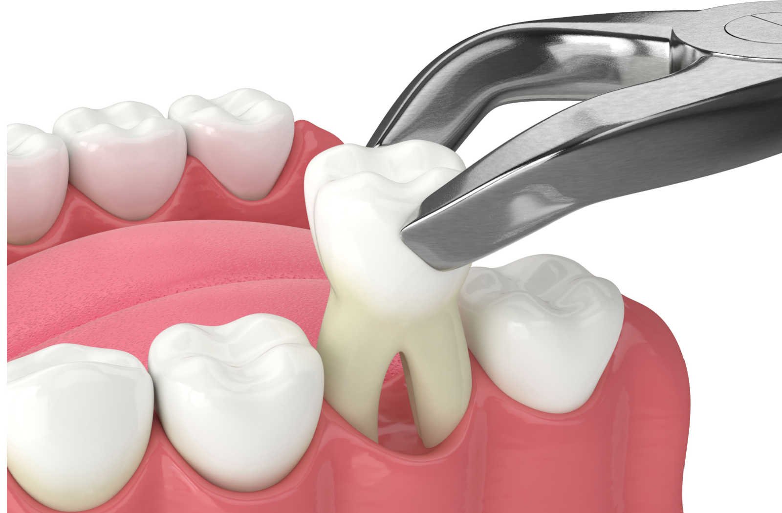 Wisdom Tooth and Extractions